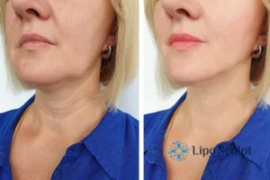Double chin before and after Hi-Fu treatment 4 Book your double chin treatment Belper today! We are here to help!