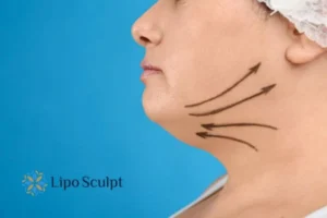 Double chin before and after Hi-Fu treatment 3 Boost your confidence with a Double chin treatment Belper