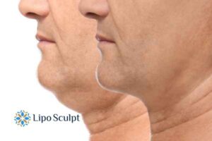 Double chin before and after Hi-Fu treatment 2 Double chin treatment Belper from Lipo Sculpt - feel more confident today!