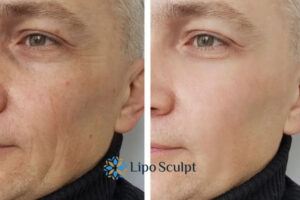 How to Fight Aging Symptoms 3 Fight Aging Symptoms Belper With HIFU and Morpheus8 Today!