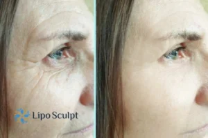 How to Fight Aging Symptoms 2 Do you want to Fight Aging Symptoms Belper? Contact Lipo Sculpt today!