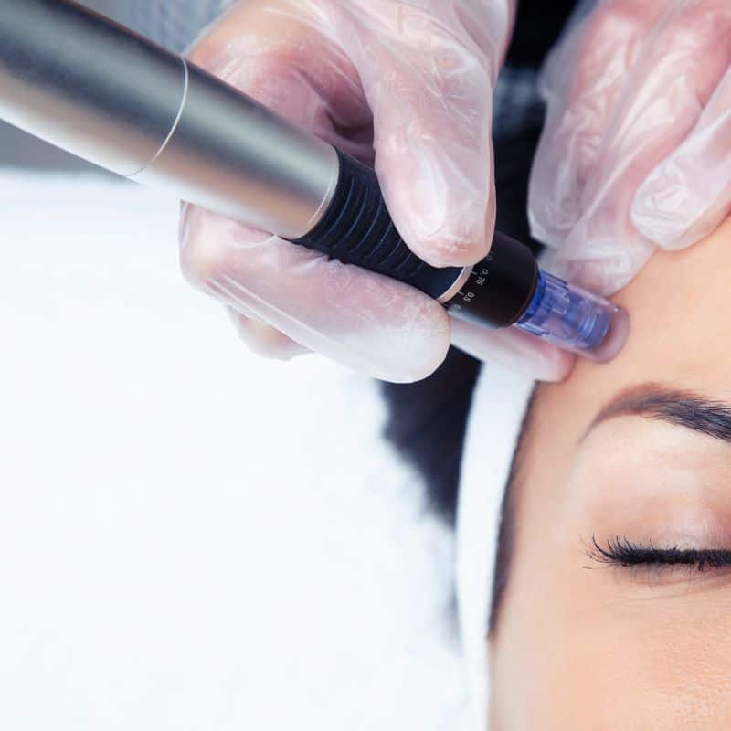 Morpheus8 treatment Belper from Lipo Sculpt - Book in today!